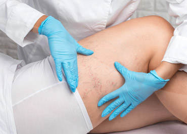 Sclerotherapy