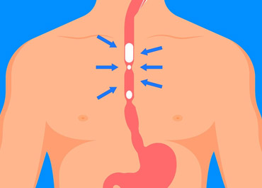 Esophageal Dilatations