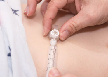 Feeding Tube Placements